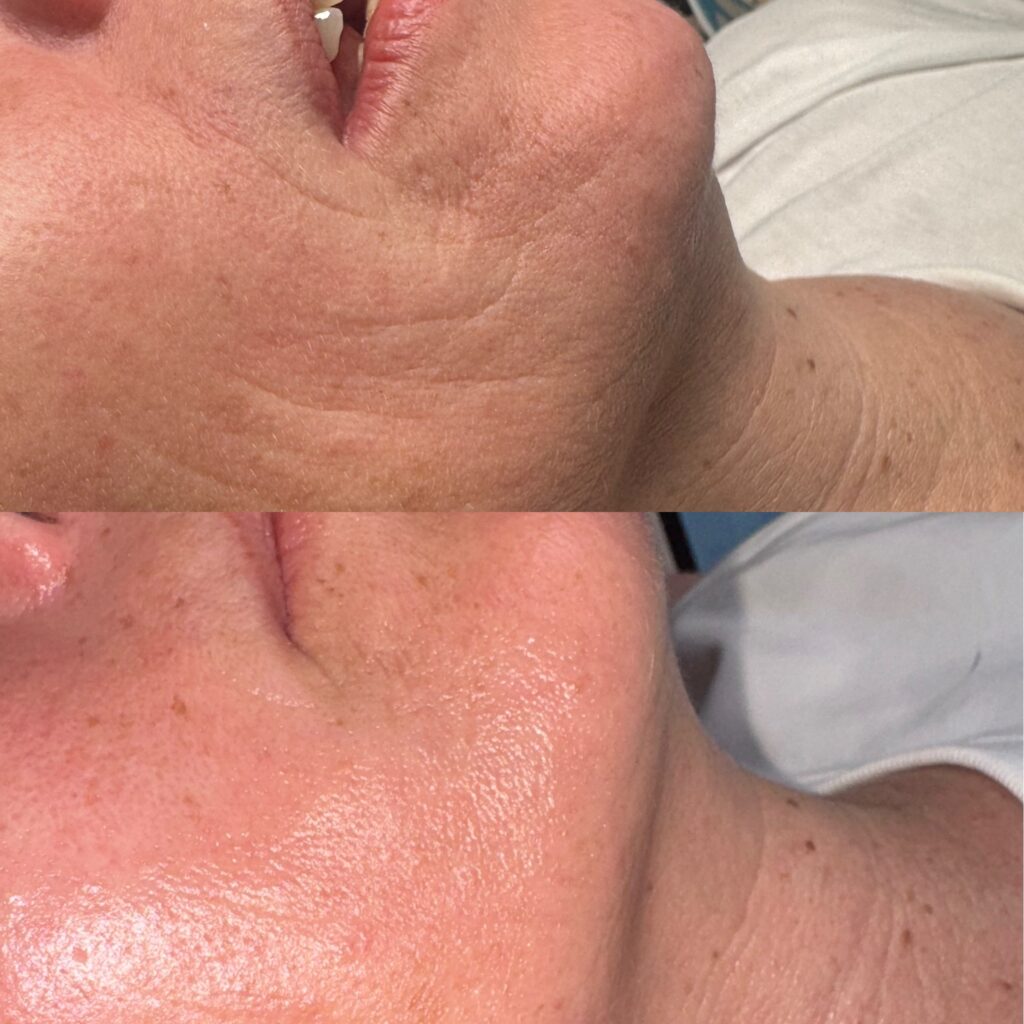 VB FACE – Lifting & Skin Tightening med EMS Face