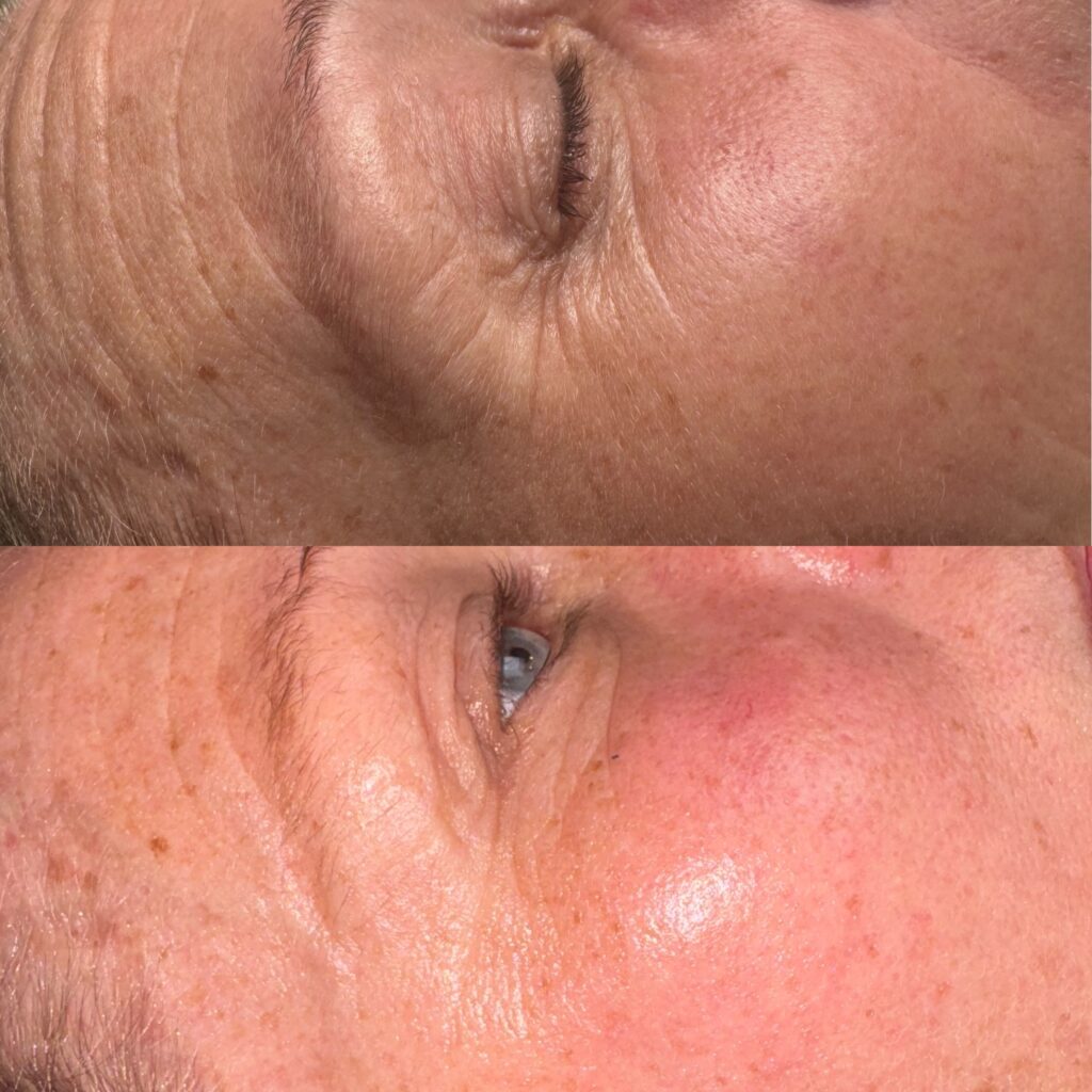 VB FACE – Lifting & Skin Tightening med EMS Face