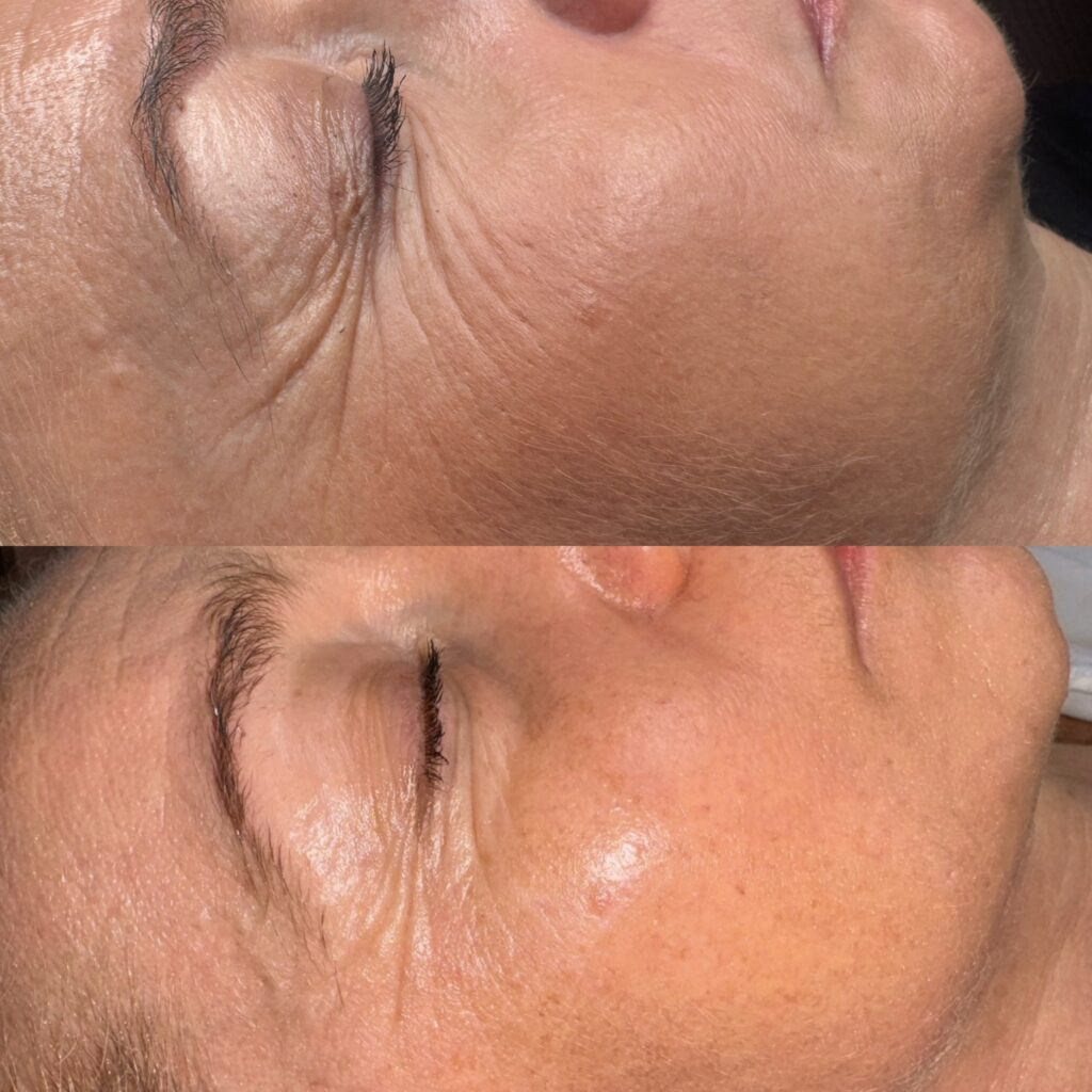 VB FACE – Lifting & Skin Tightening med EMS Face